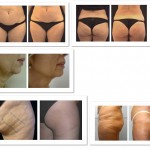 Laser-Skin-Tightening-and-Body-Contouring