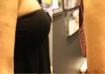 RF-before-after-arm-side-300x106