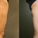 accent-cellulite-revision-ba