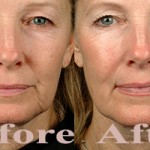skintightening