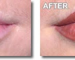 Lips 2 BeforeAfter Lips 2 BeforeAfter
