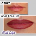 Lips BeforeAfter Lips BeforeAfter